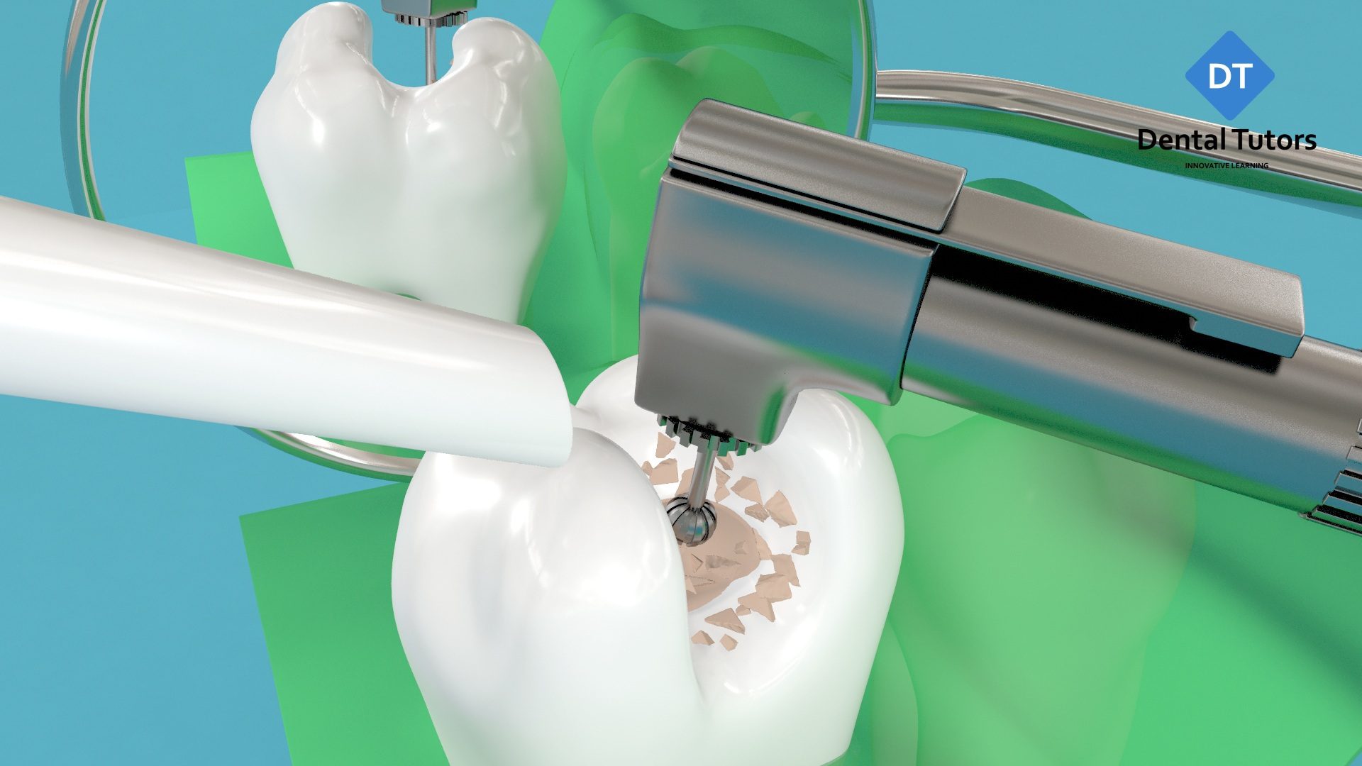 Dental Animation - Root Canal Treatment