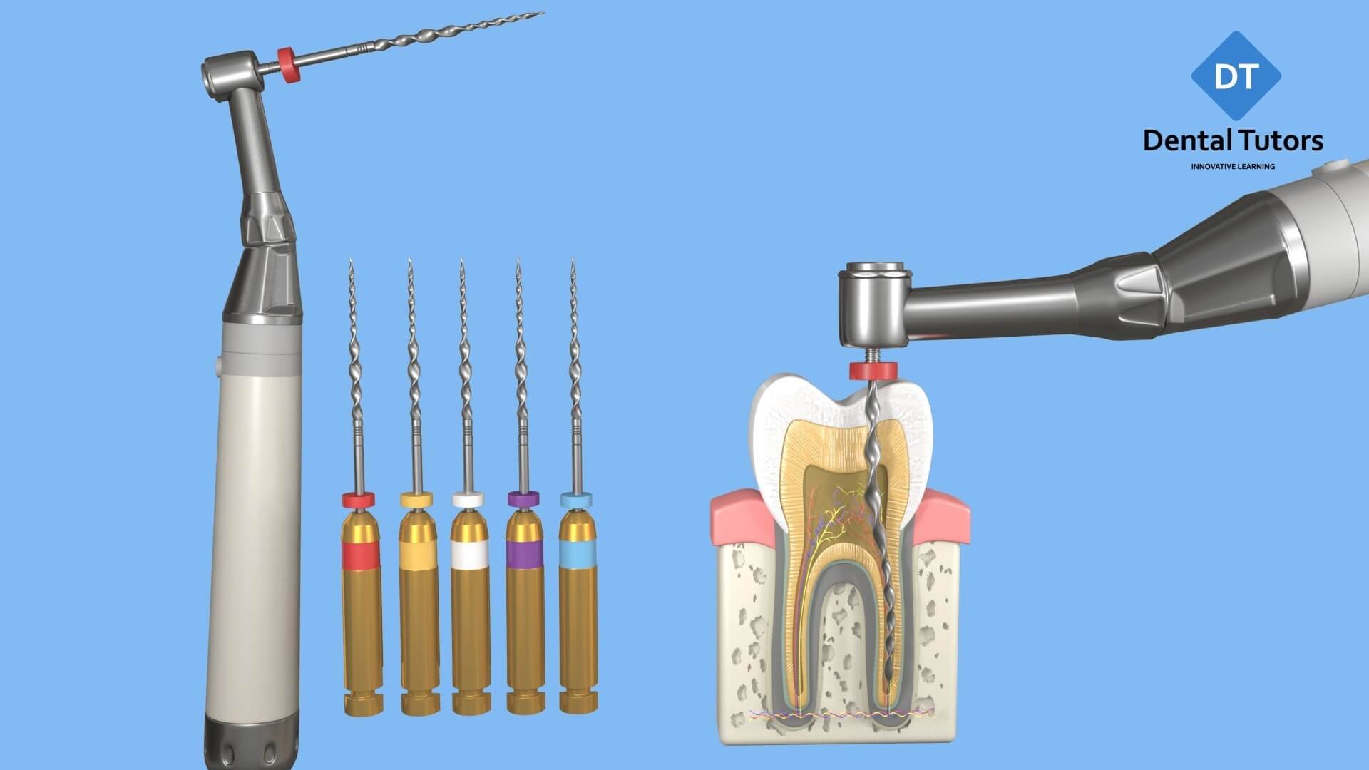 Root Canal Treatment - Files